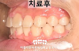 수술후