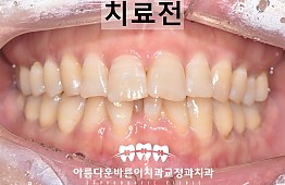 수술전