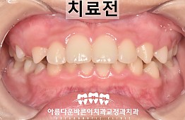 수술전