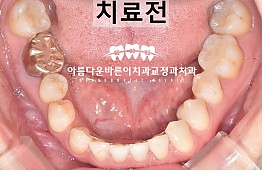 수술전