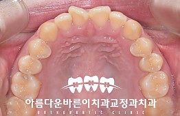 수술전