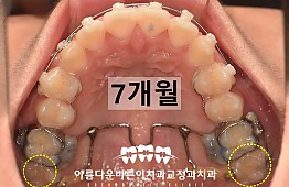 수술후