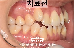 수술전