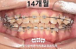 수술후