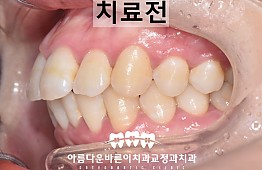 수술전