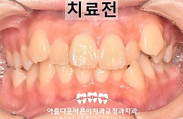 수술전