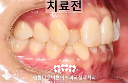 수술전