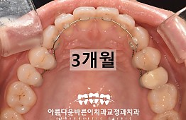 수술후