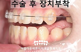 수술전