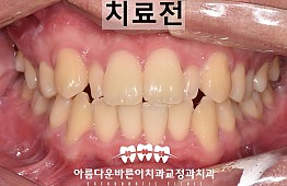 수술전