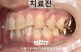 수술전