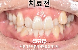 수술전