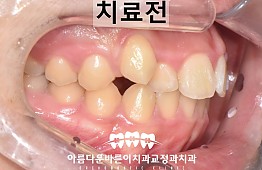 수술전