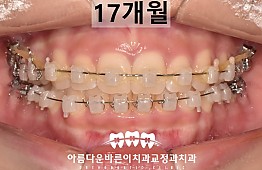 수술후