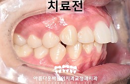 수술전