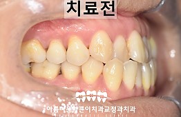 수술전