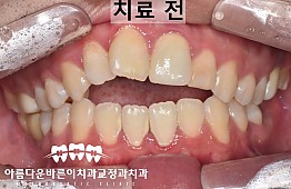 수술전