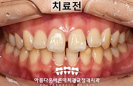 수술전