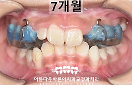 수술후