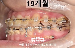 수술후