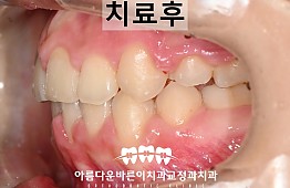 수술후