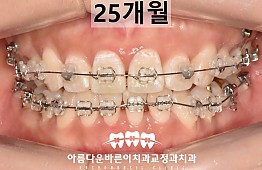 수술후