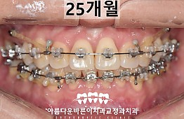 수술후