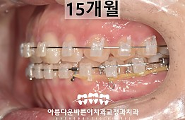 수술후