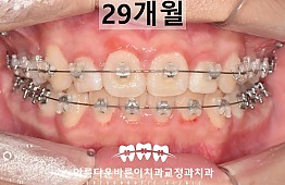 수술후