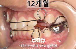 수술후