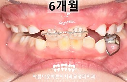 수술후