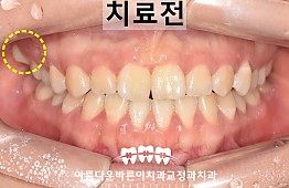 수술전