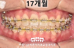 수술후