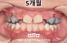 수술후