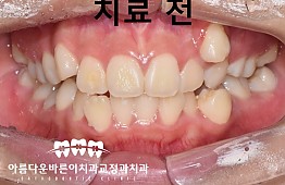 수술전