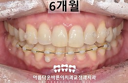 수술후