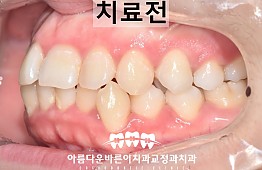 수술전