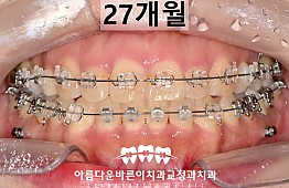 수술후