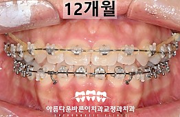 수술후