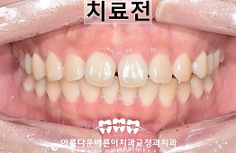 수술전