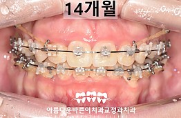 수술후