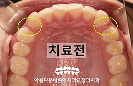 수술전