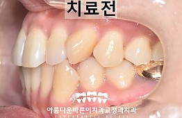 수술전