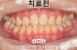 수술전