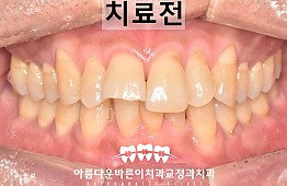 수술전