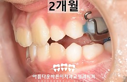 수술후