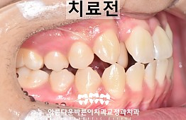 수술전