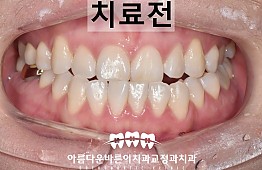 수술전