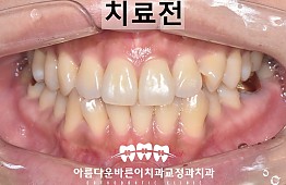 수술전