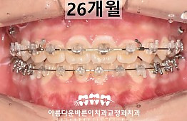 수술후